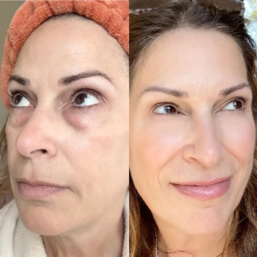 Claréa Glow® Red Light Therapy + EMS To Erase Eye Bags